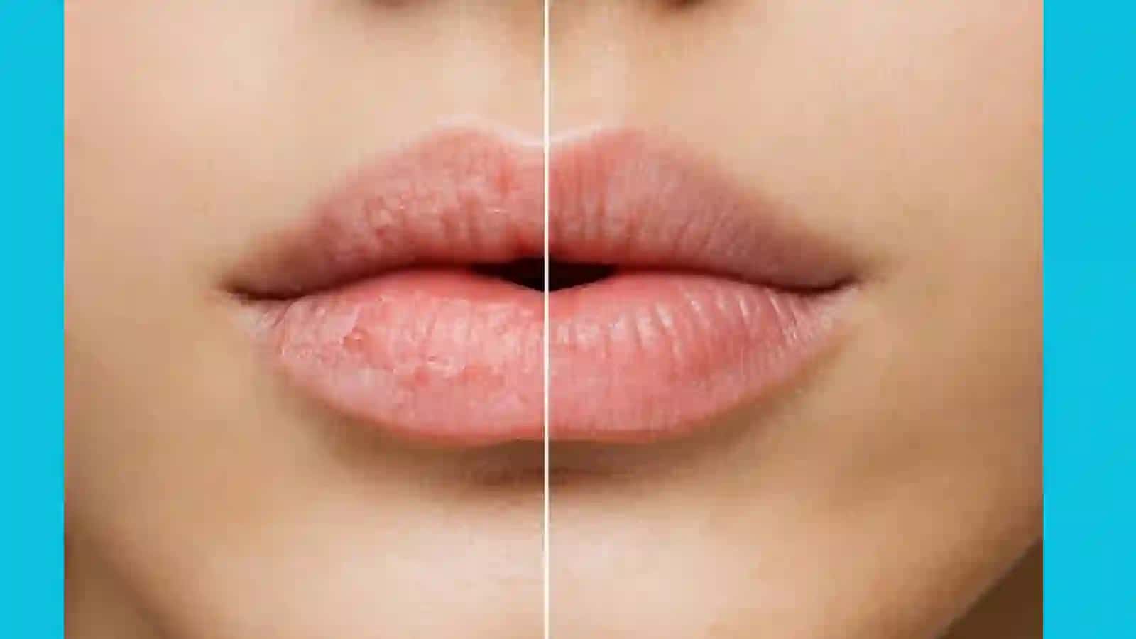ХЕЙЛИТЫ. ПРЕДРАКОВЫЕ ЗАБОЛЕВАНИЯ КОЖИ И СЛИЗИСТЫХ ОБОЛОЧЕК 3