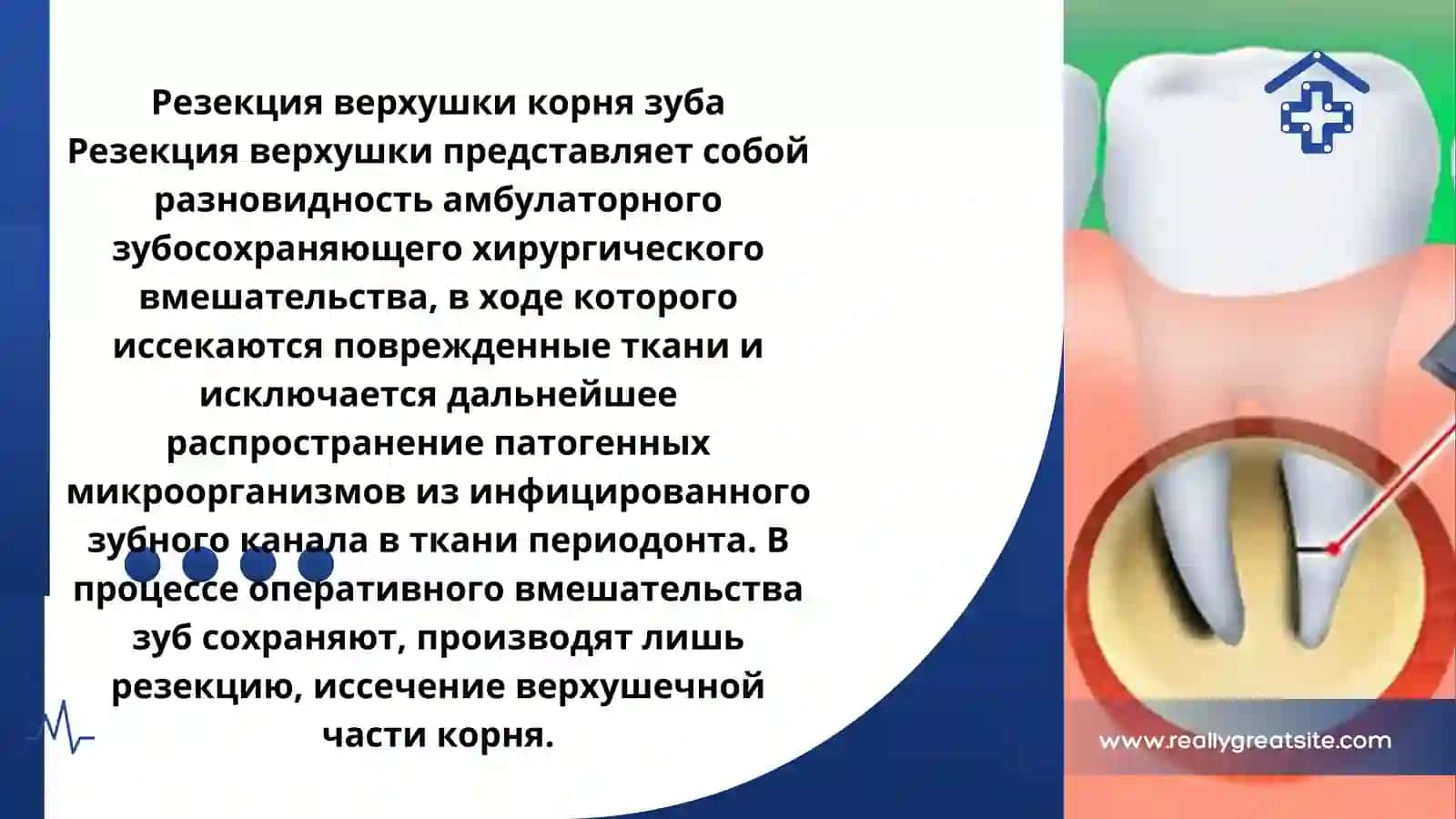 Зубосохраняющие операции 3