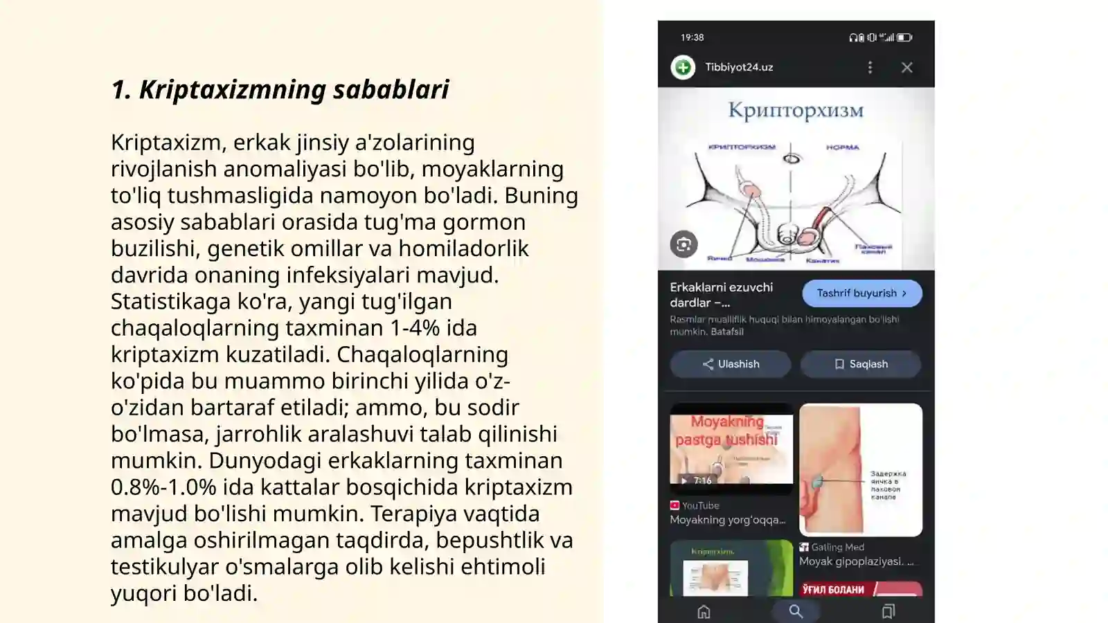 Kriptaxizm va uni davolash 3