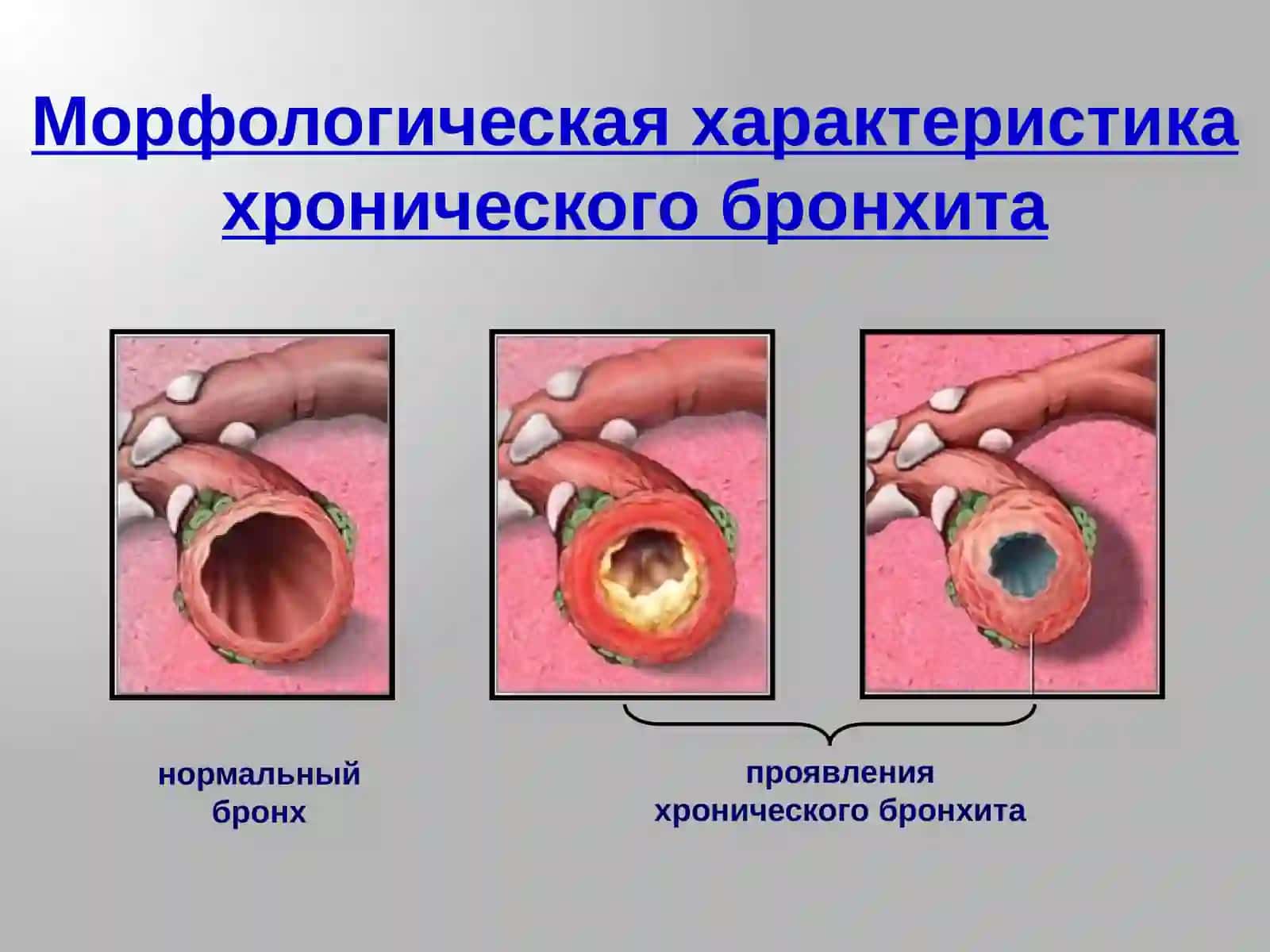 Хроническая обструктивная болезнь легких 3