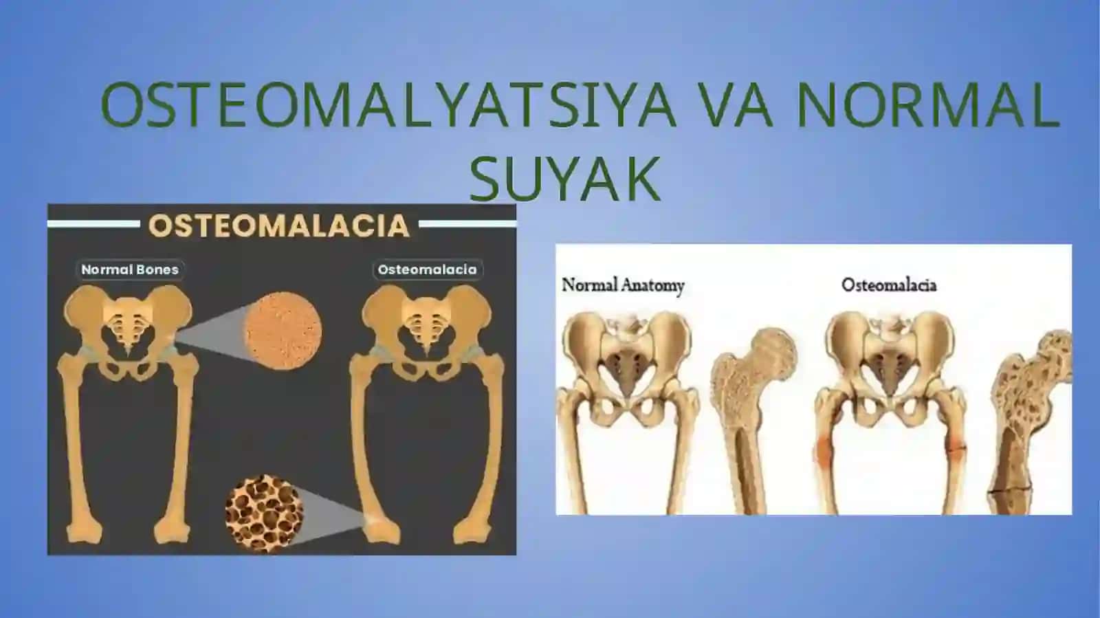 Osteomalyatsiya 3
