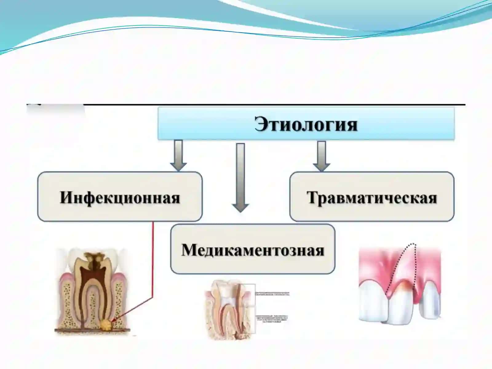 Острый апикальный периодонтит - клиника,диагностика 3