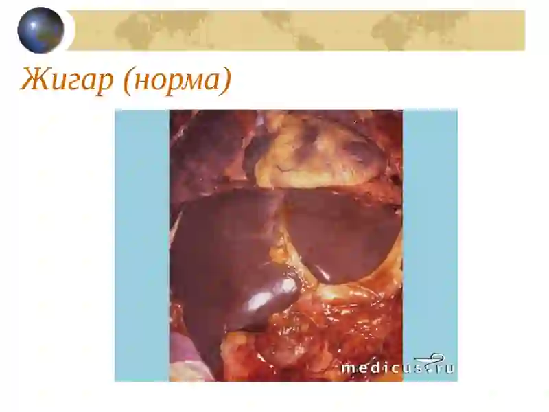 Сурункали гепатит 3