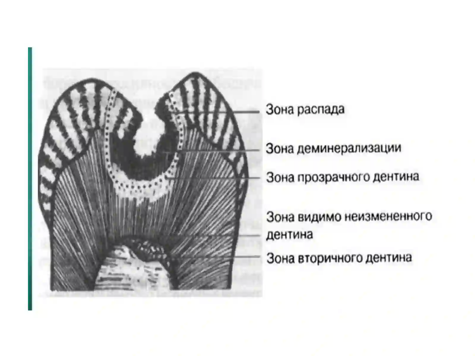 Тиш қаттиқ тўқималарини чархлаш босқичлари ва тамойиллари 3