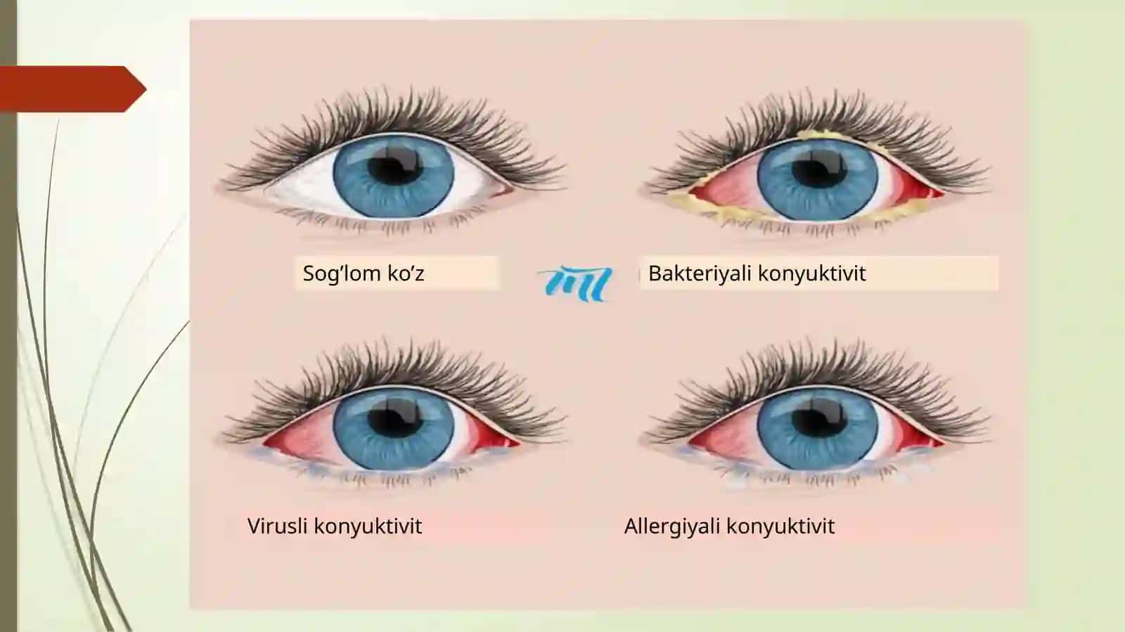 Konyuktivitlar kasalligi 3