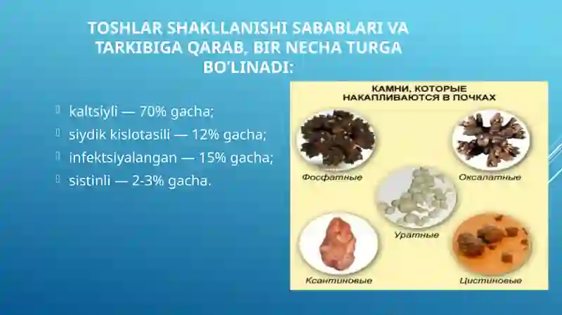 Siydik tosh kasalligi 3