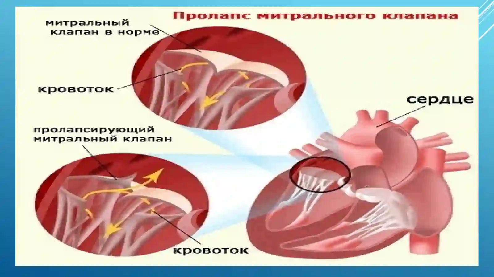 MITRAL KLAPAN PROLAPSI 3