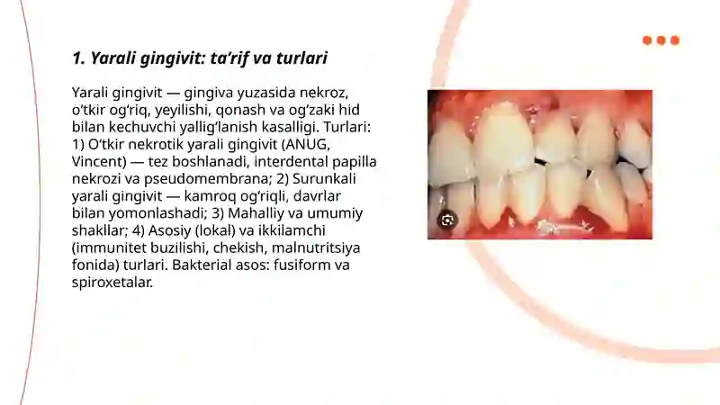 Yarali gingivit 3