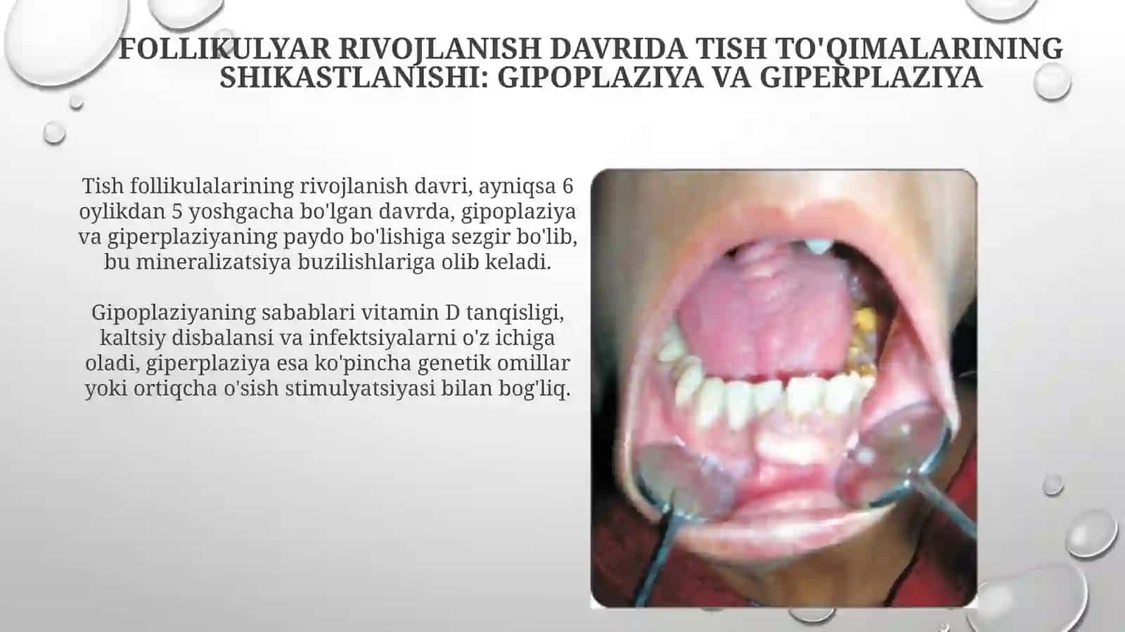 Follikulyar rivojlanish davrida tish to'qimalarining shikastlanishi: Gipoplaziya va Giperplaziya 3