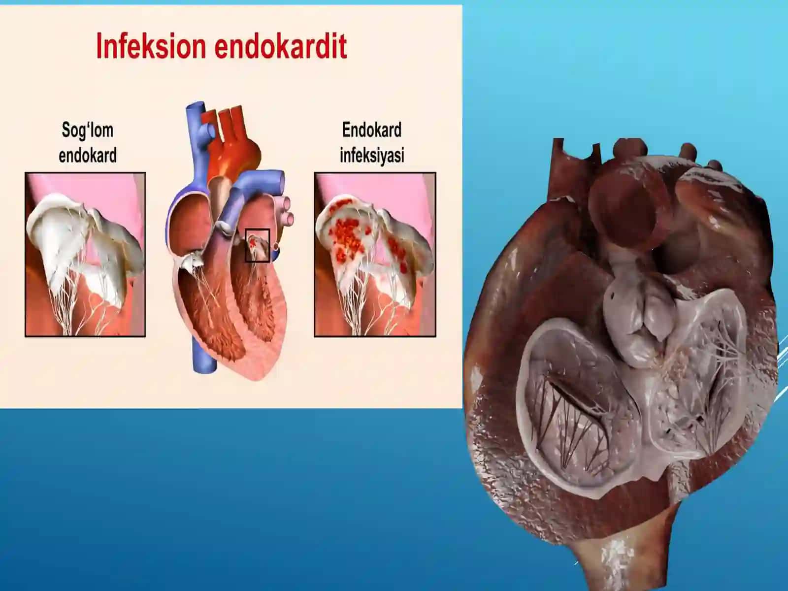 INFEKSION ENDOKARDIT 3