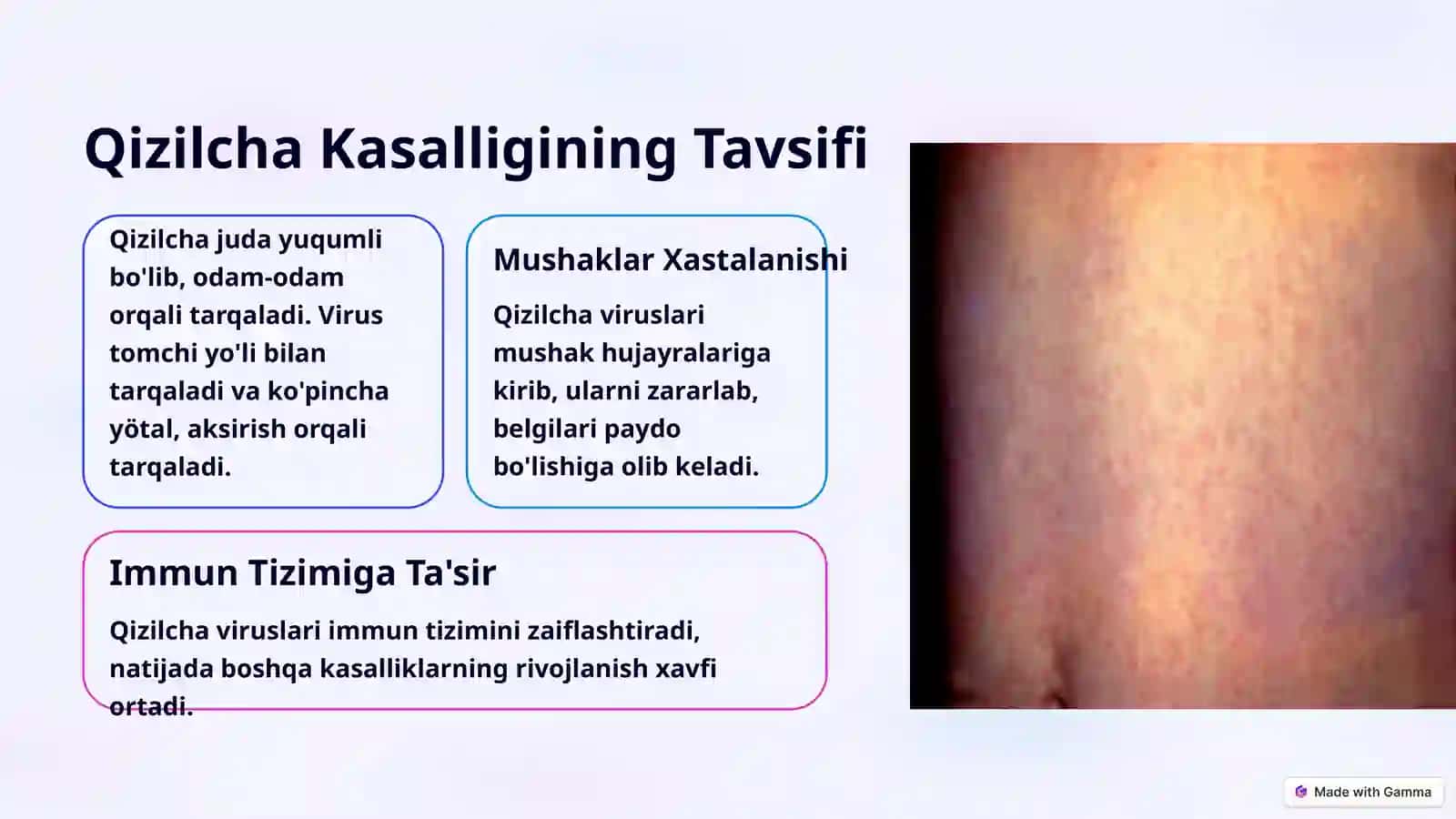 EPIDEMIOLOGIYA fanidan tayyorlagan TAQDIMOTI. Qizilcha Kasalligi 3