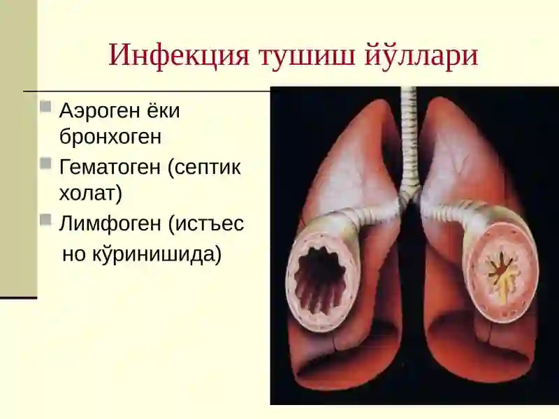 Пневмония 4