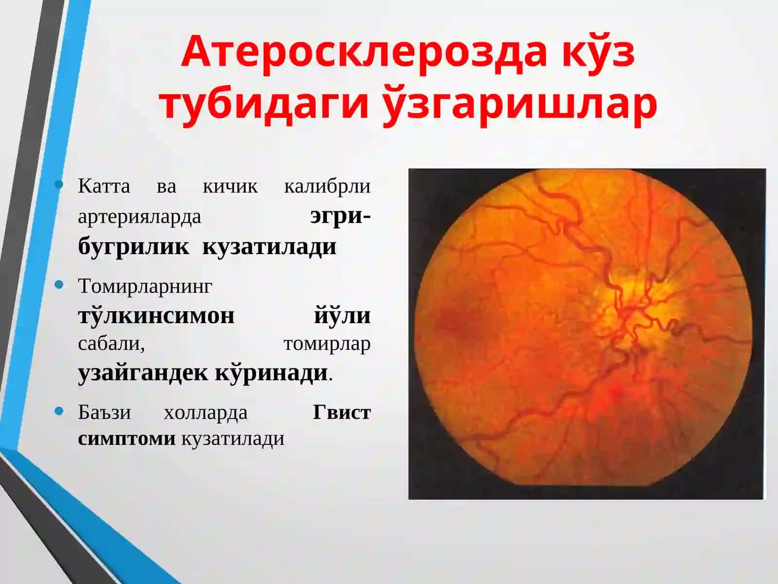 umumiy kasalliklarda kuzatiladigon ko'zdagi o'zgarishlr 4