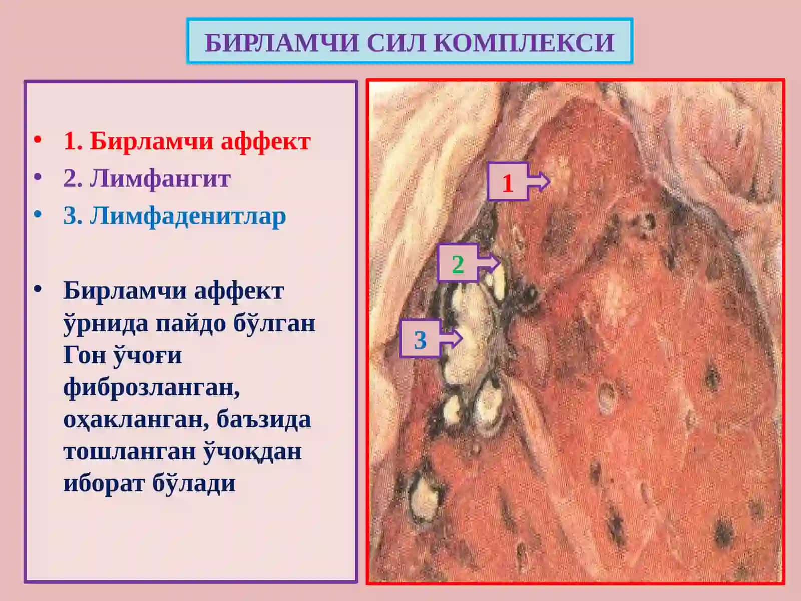 Сил - туберкулез 4