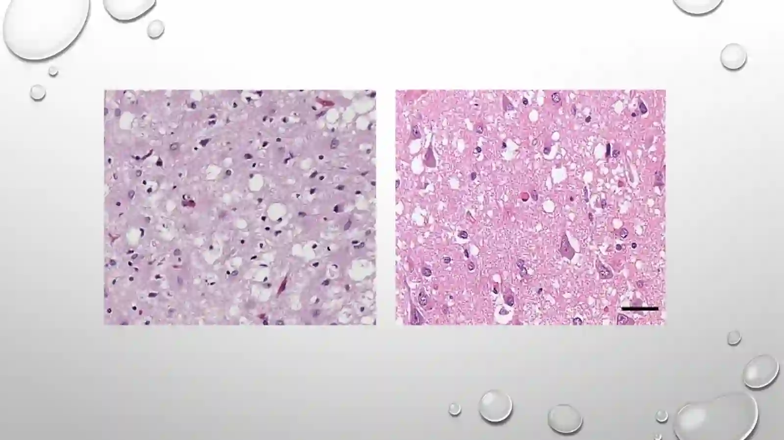 prion kasalliklari 4