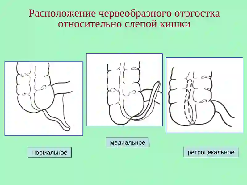 Острый аппендицит 4