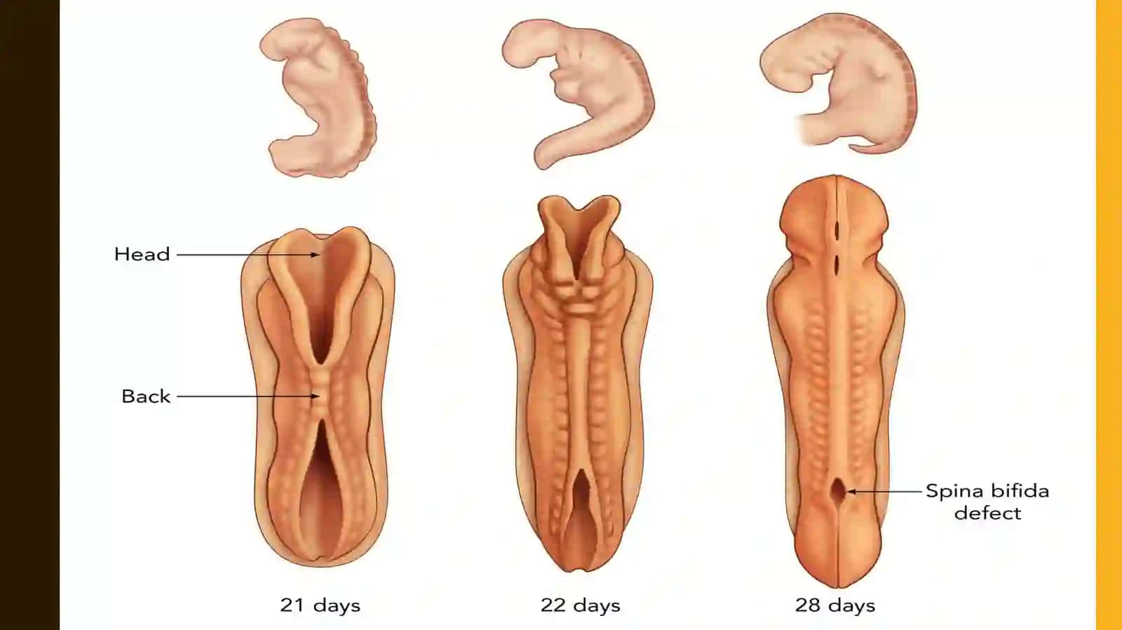 Spina bifida 4