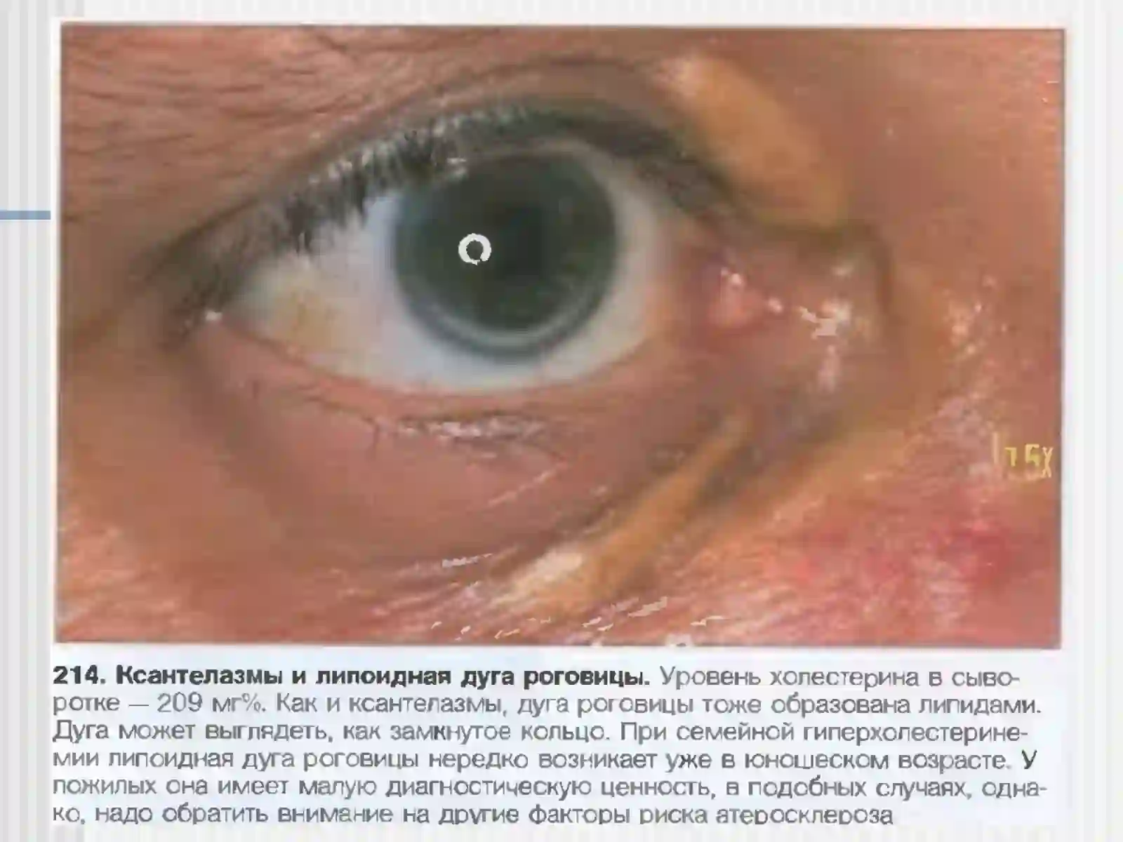 Атеросклероз 4