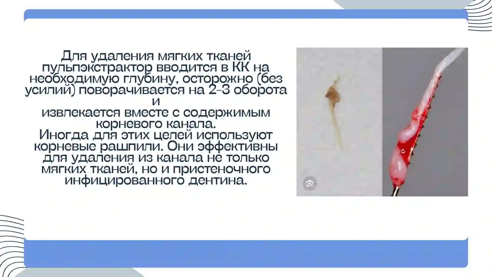 Методы инструментальной обработки корневых каналов (Step Back, Crown Down, сбалансированной силы) 4