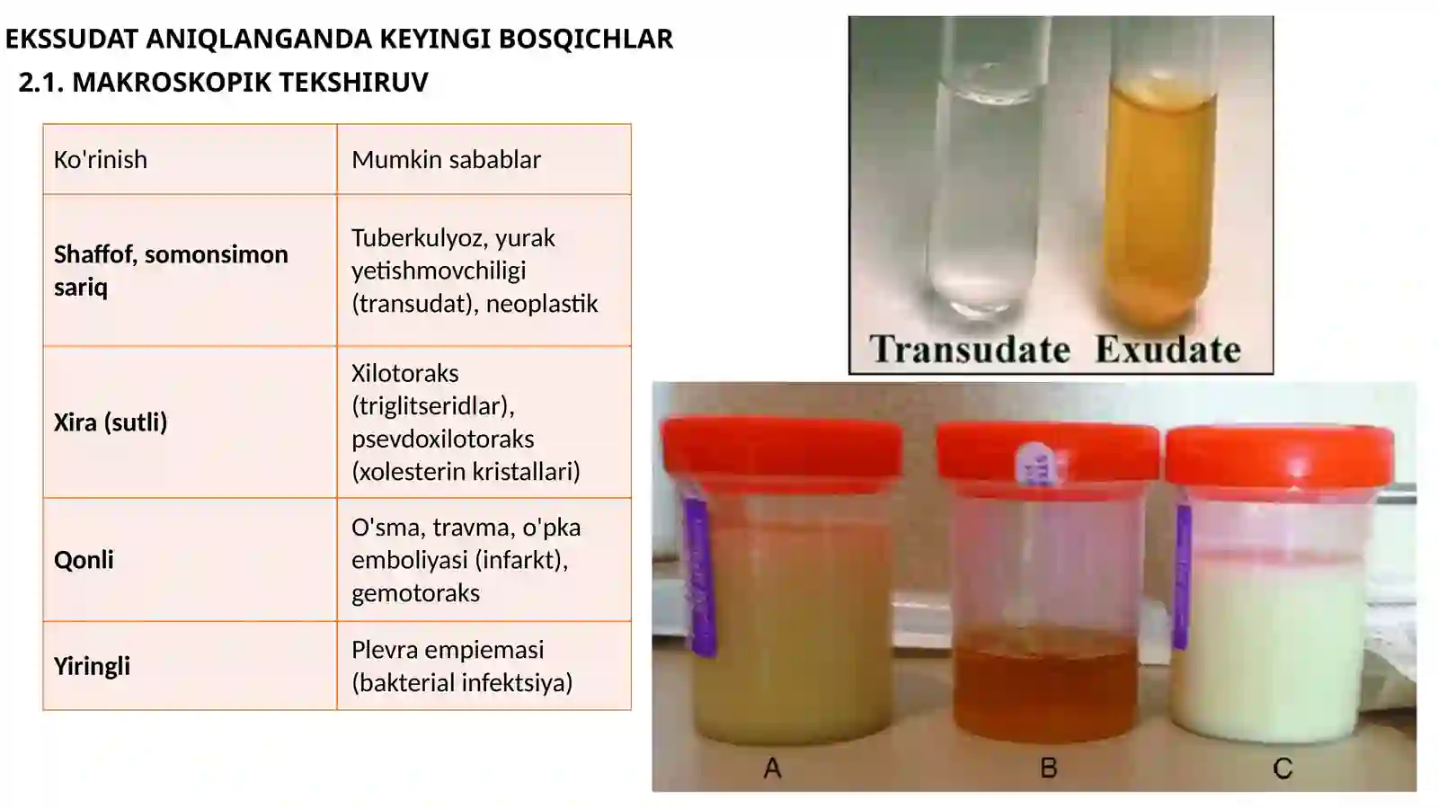 Plevral ekssudat asosida differensial diagnostika 4