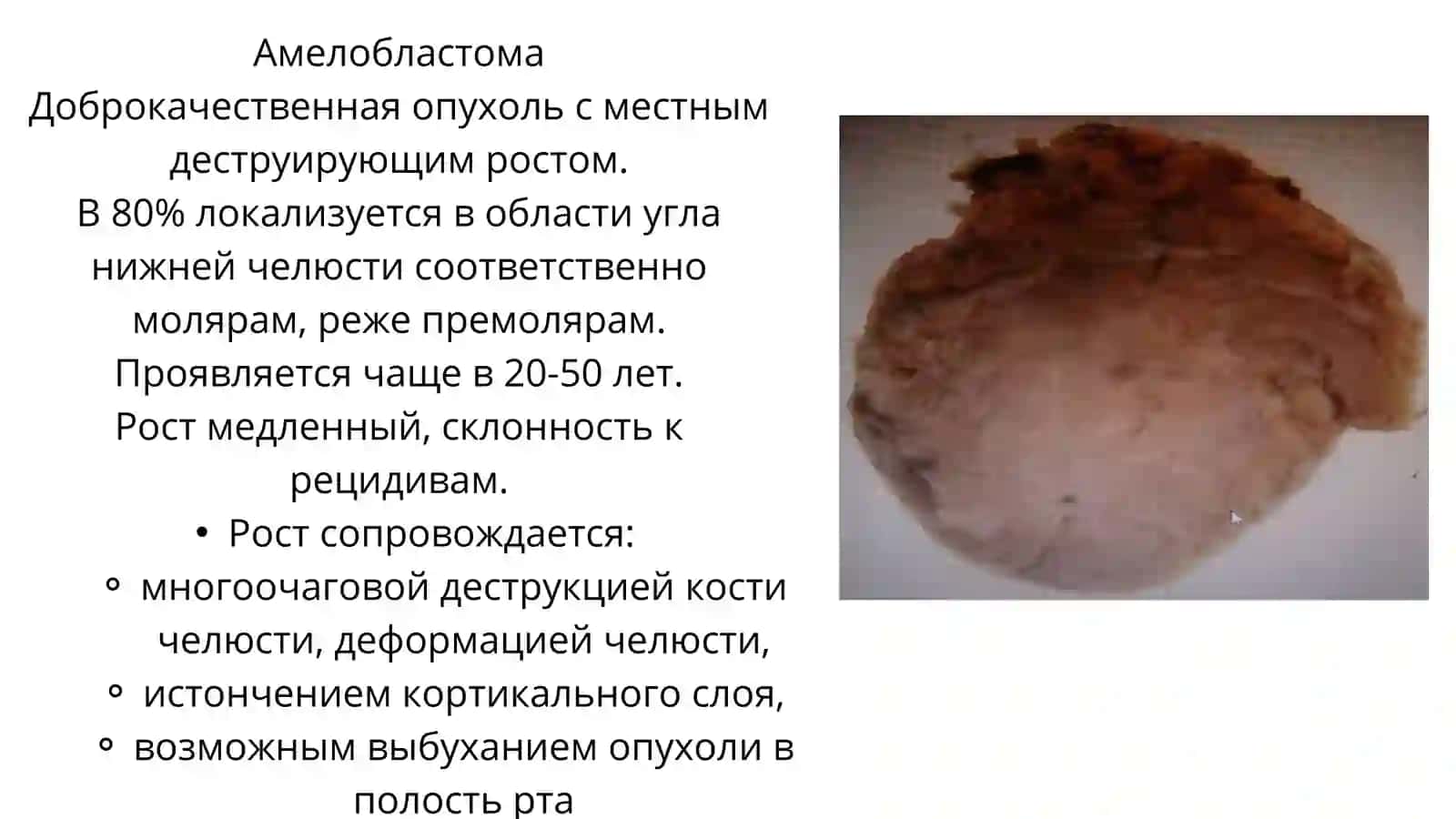 Одонтогенные опухоли 4