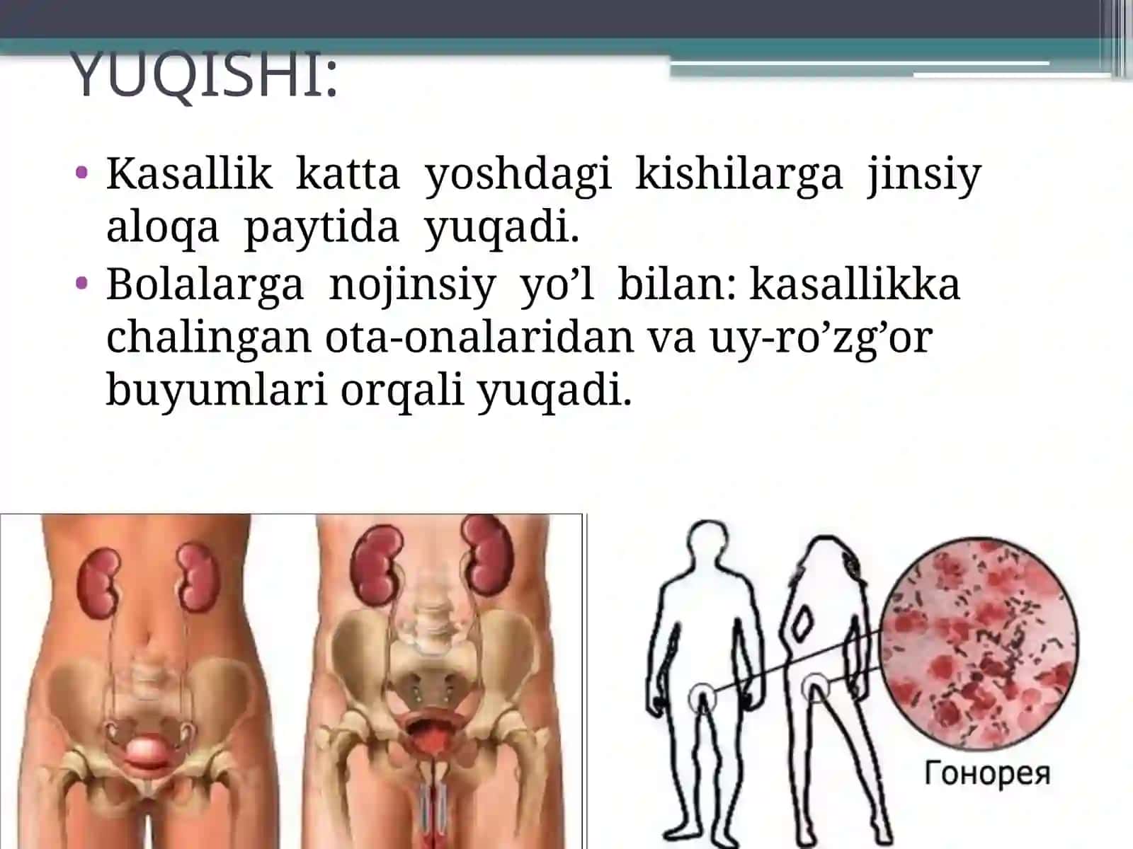 So’zak  siydik-tanosil  a’zolari  kasalligidir. 4