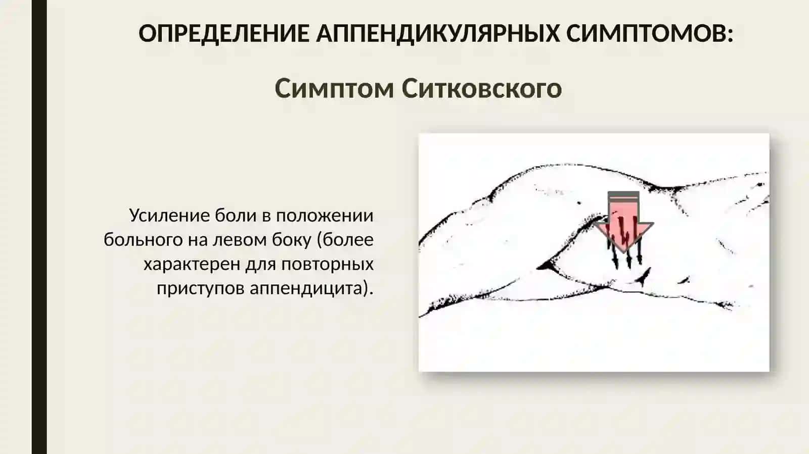 Ректальное исследование при тазовом аппендиците 4