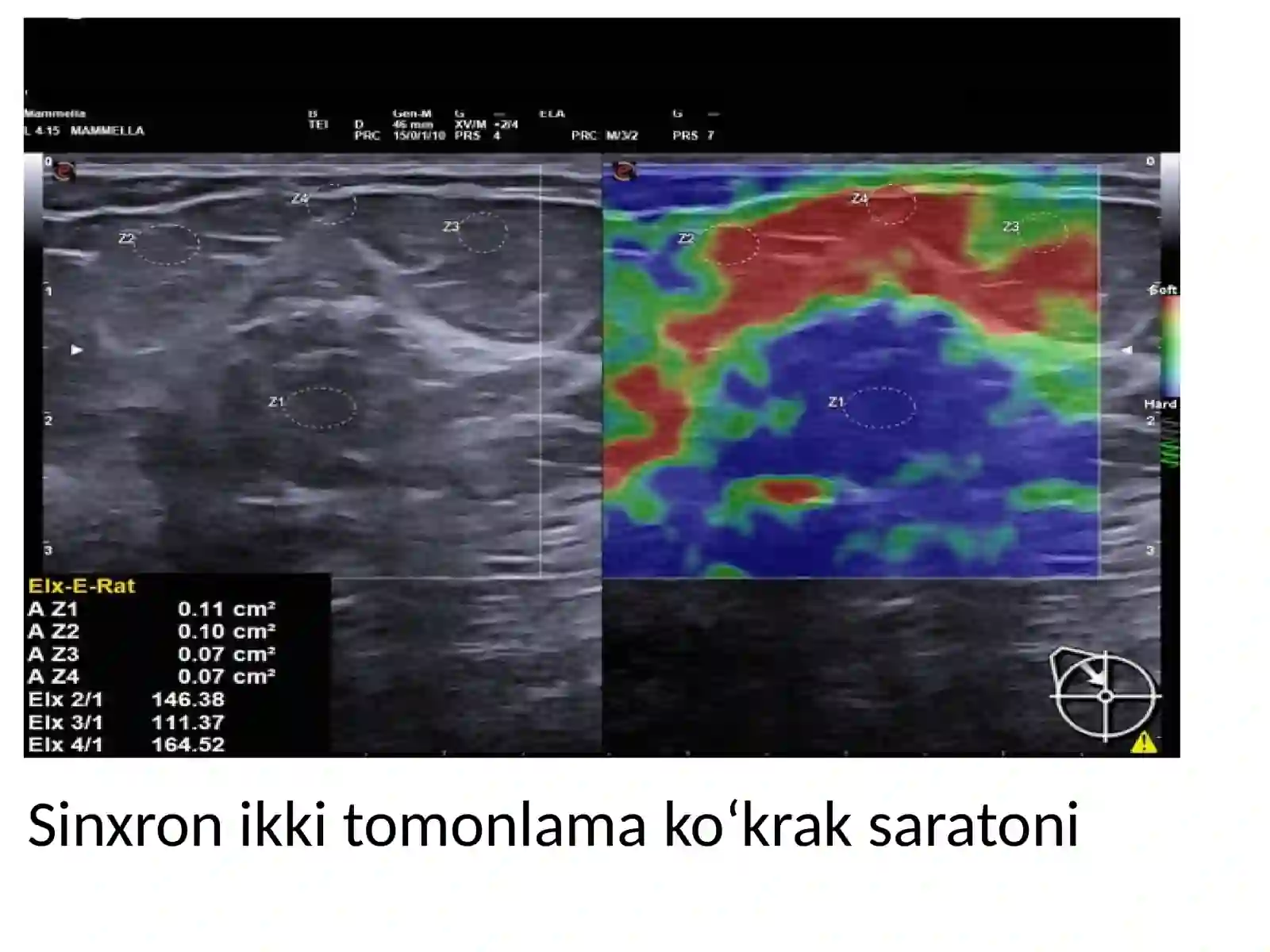 Elastografiya 4