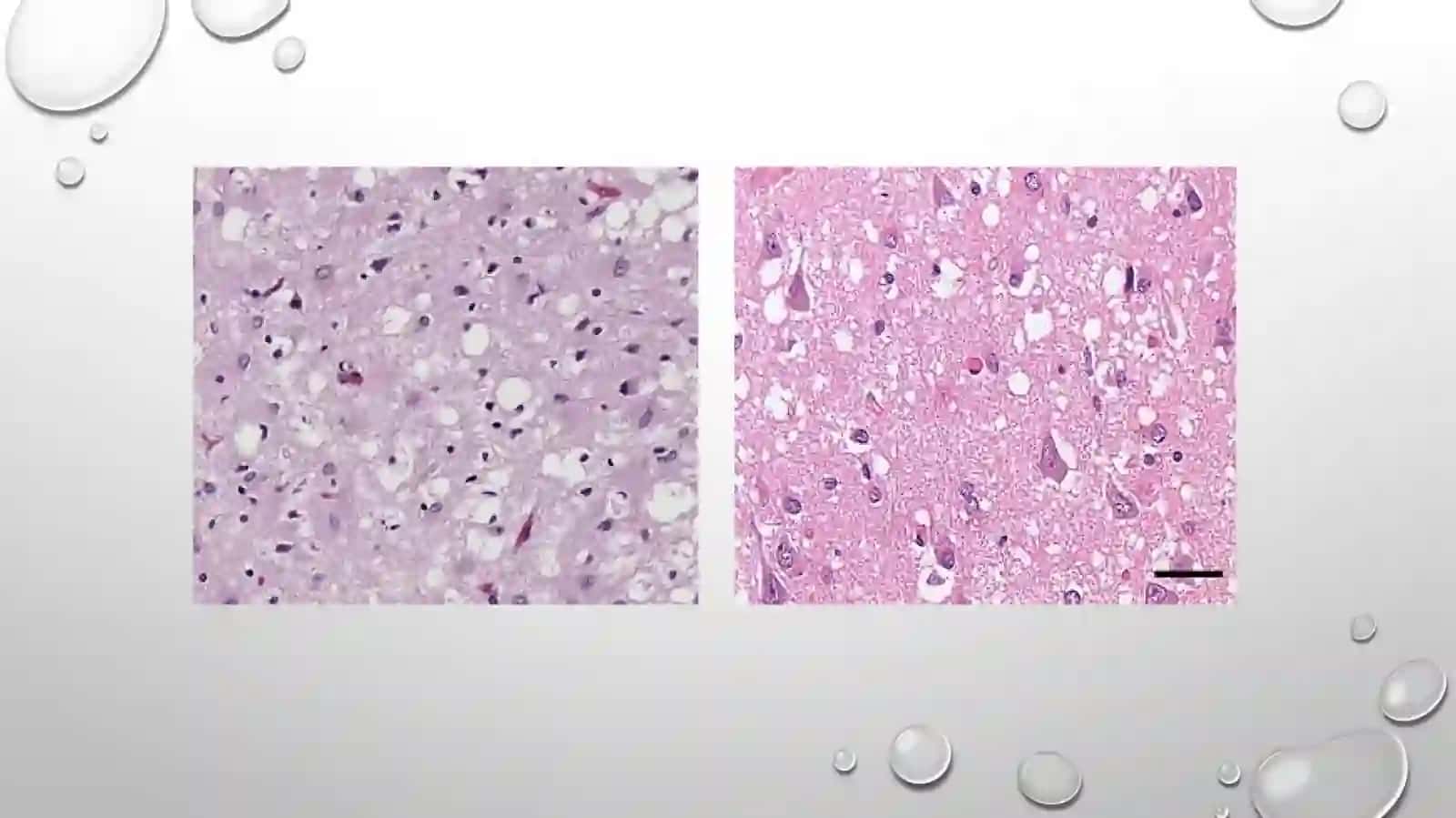 Prion kasalliklari 4