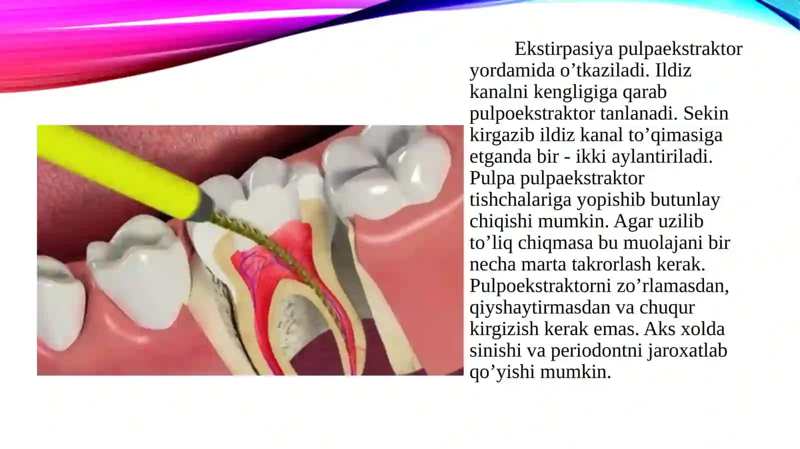 Devitalekstrepatsiya usuli 4