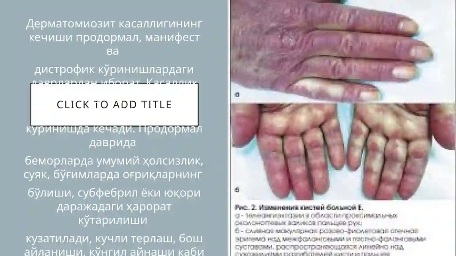 Dermatomiozitlar. Vitiligoning zamonaviy davolash usullari 4