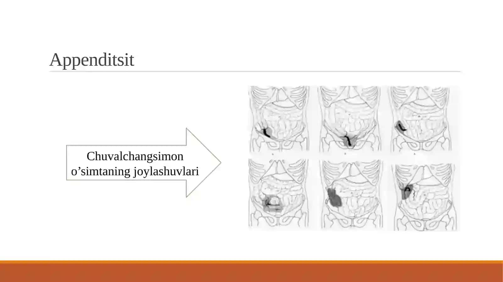 Otkir appenditsit 4