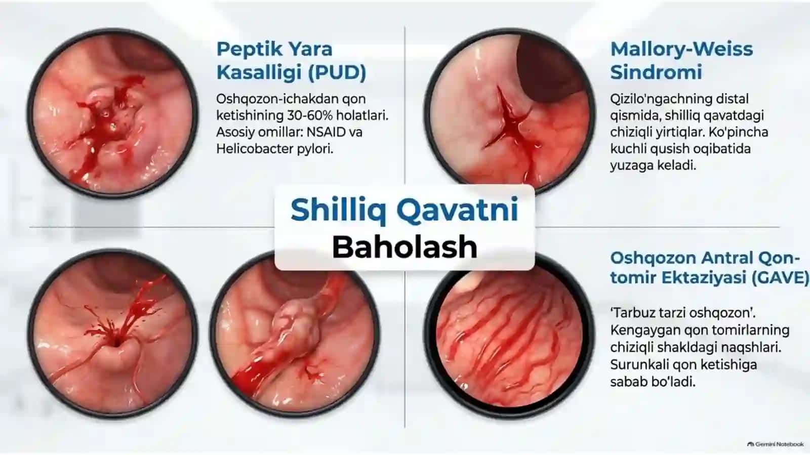 Ezofagogastroduodenoskopiya (EGDS): diagnostika, davolash va endoskopik gemostaz | 15 slayd 4