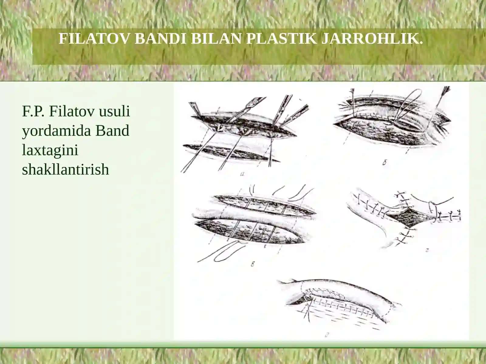 FILATOV BANDIBILAN PLASTIK JARROHLIK 4