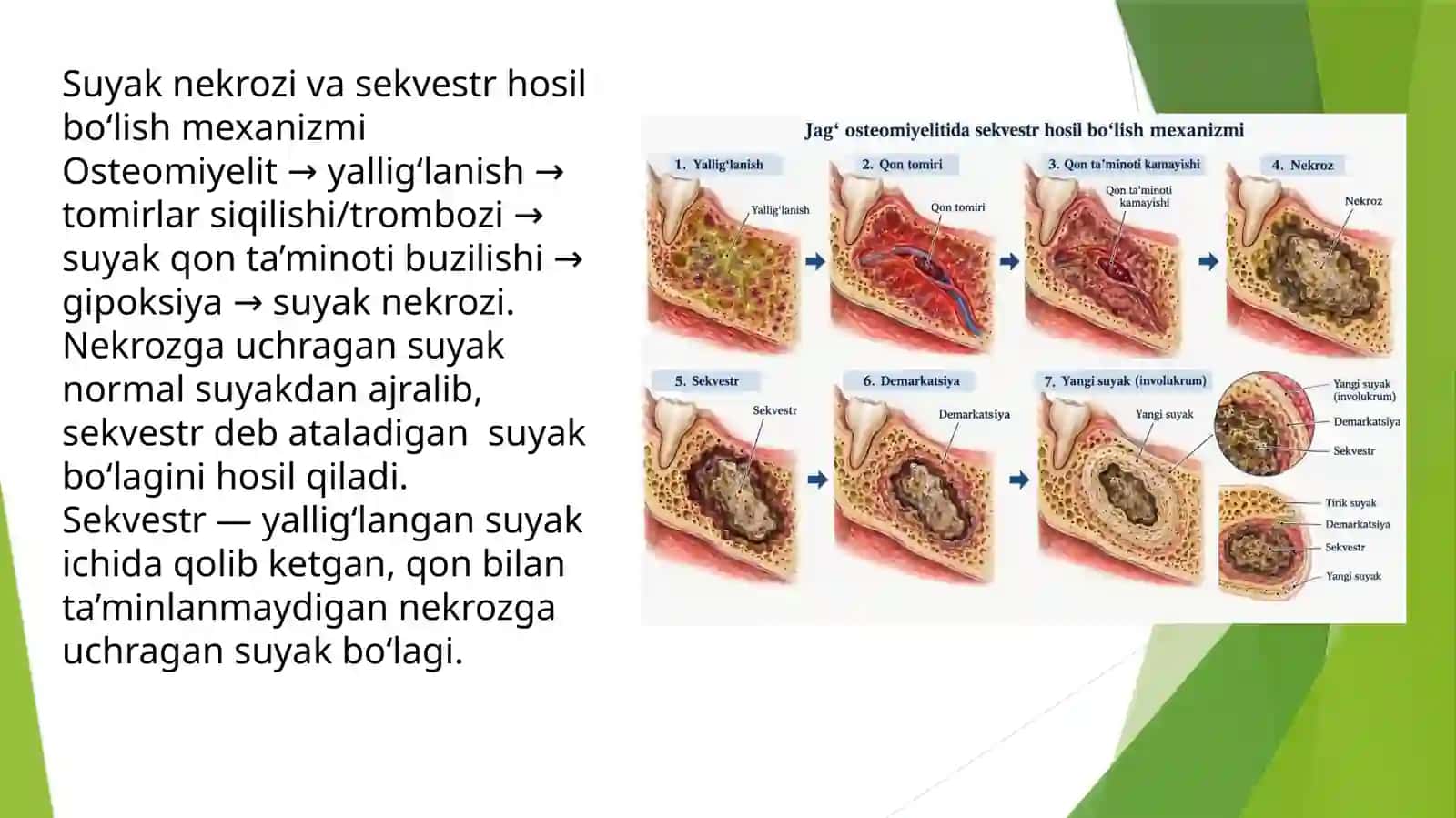 Yuqori va pastki jag'osteomiyeliti 4