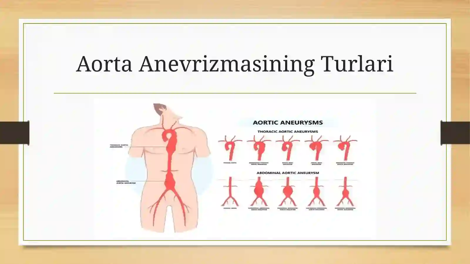 Aorta anevrizmasi 4