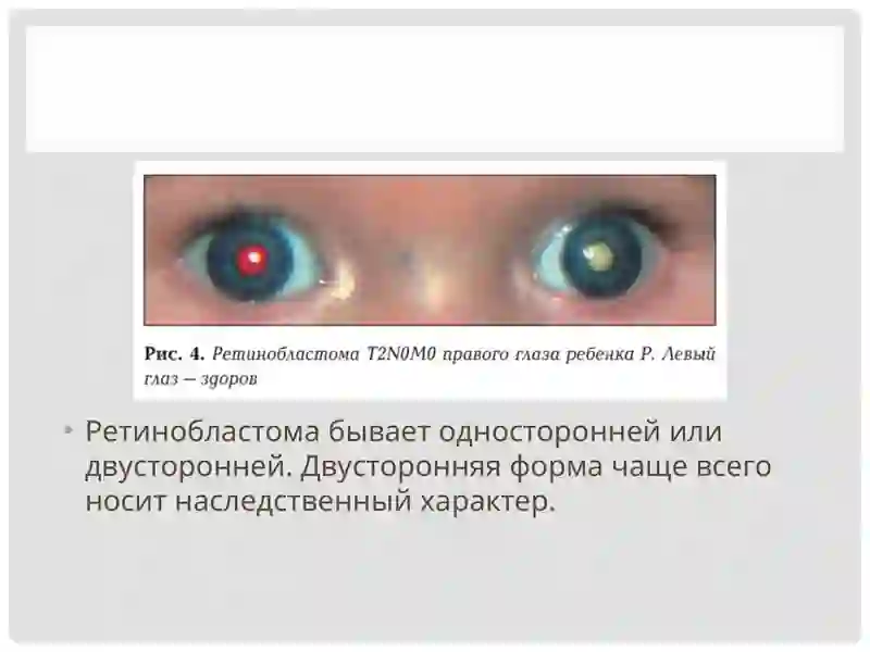 Ретинобластома 4