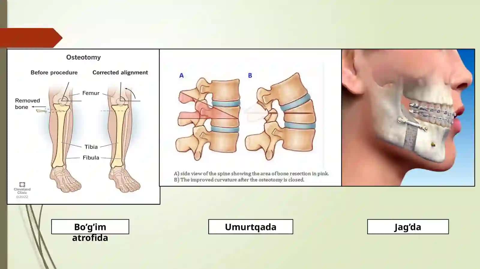 Osteotomiya 4