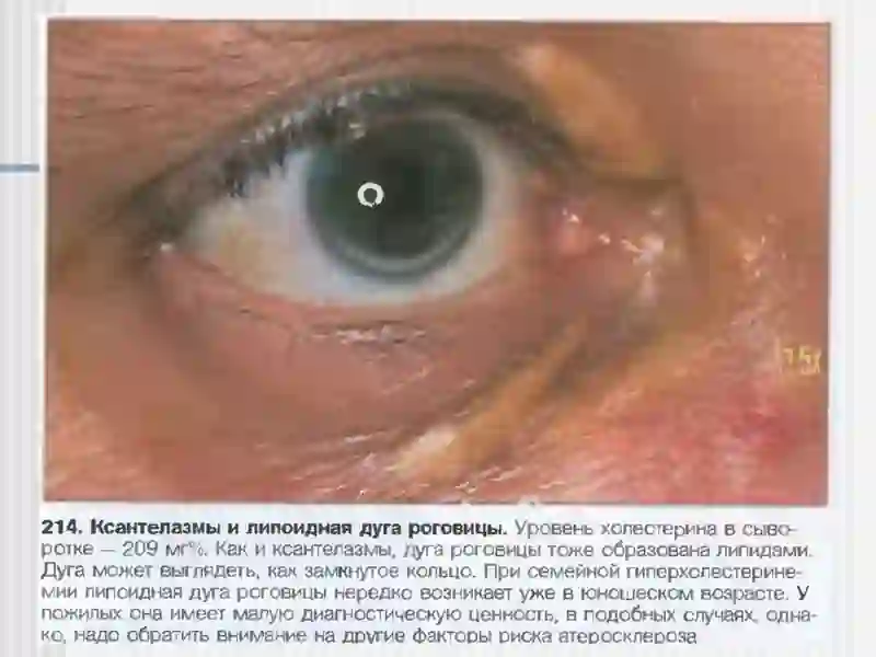 АТЕРОСКЛЕРОЗ 4