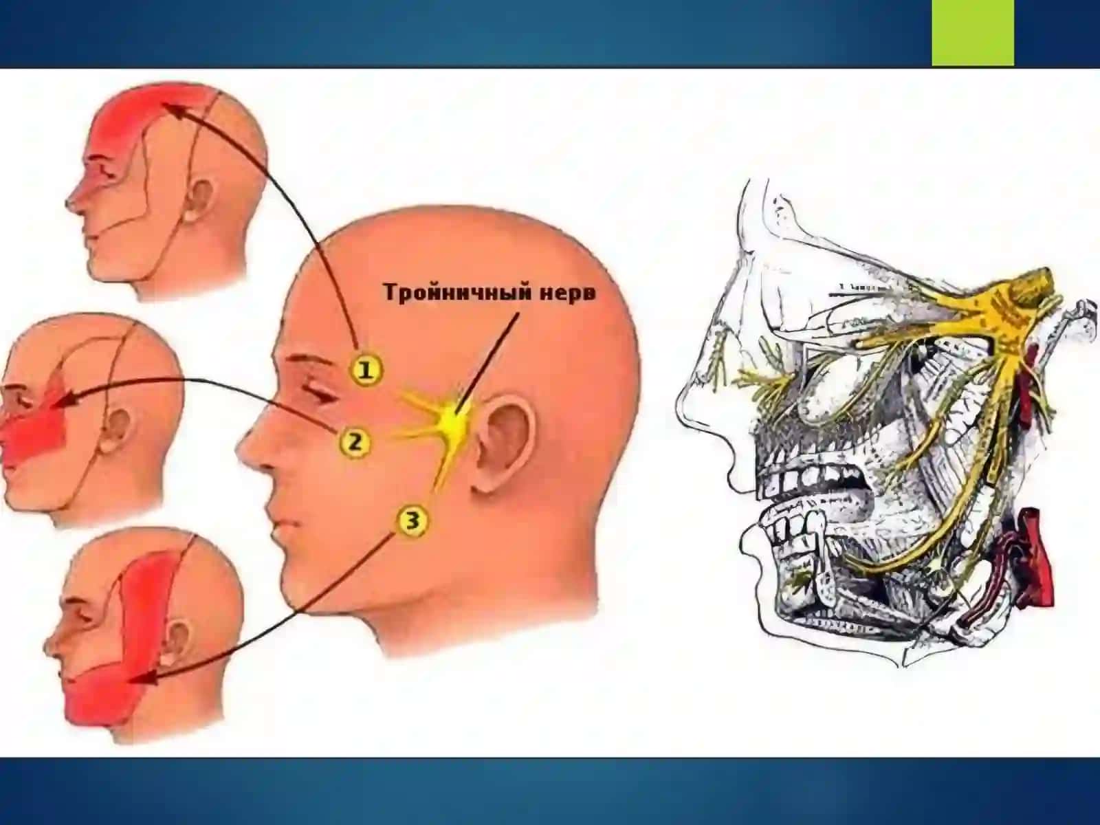 Nevralgiya stomatologiyadagi sindromlari 4
