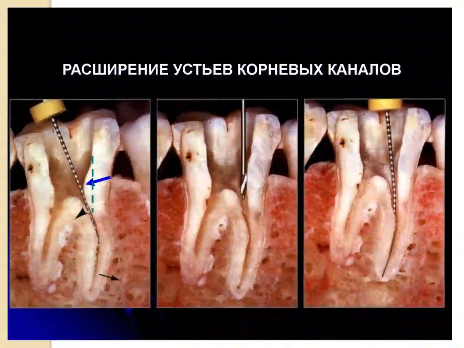 Методики обработки корневых каналов 4