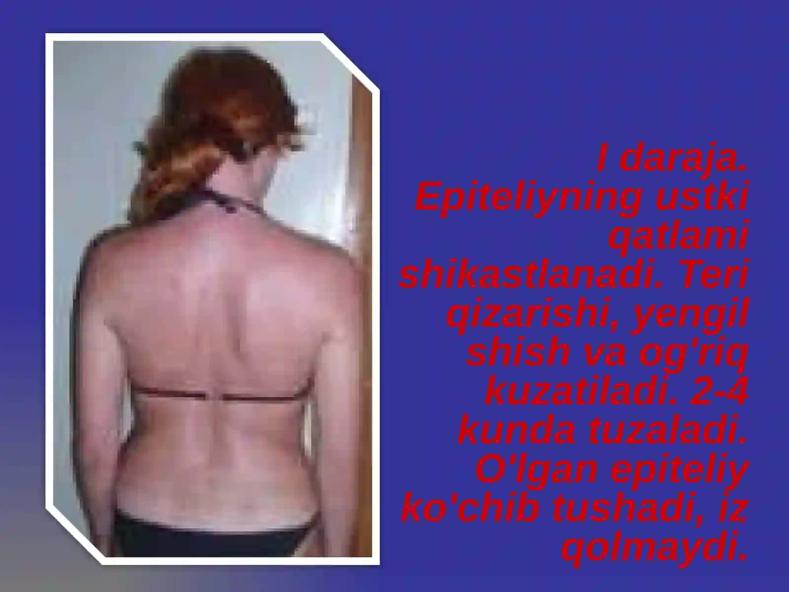 Kuyish jarohatlari va ularning tasnifi (PPTX) 4