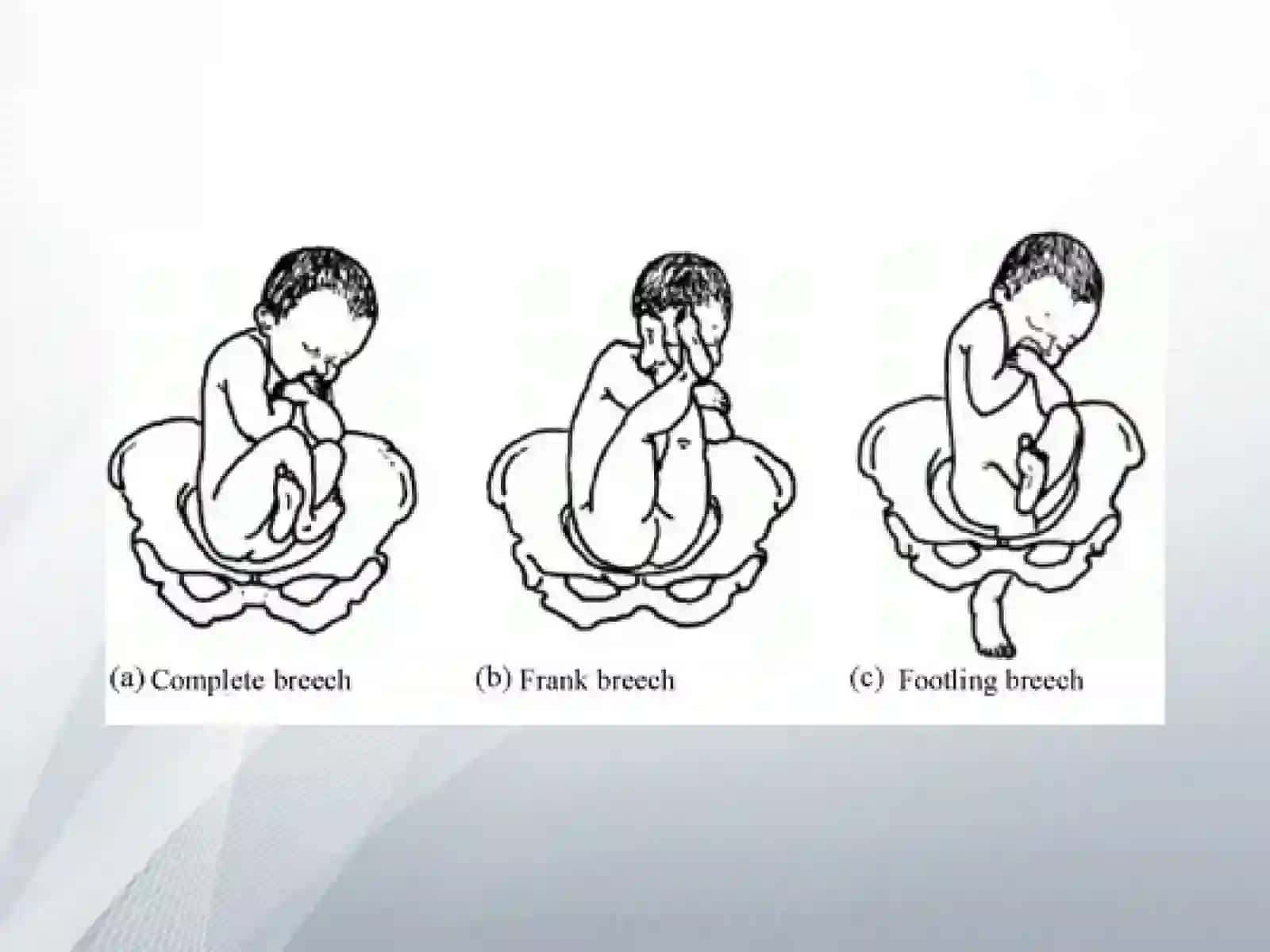 Homilaning Chanoq bilan kelshi(praesentatio pelvica) 4