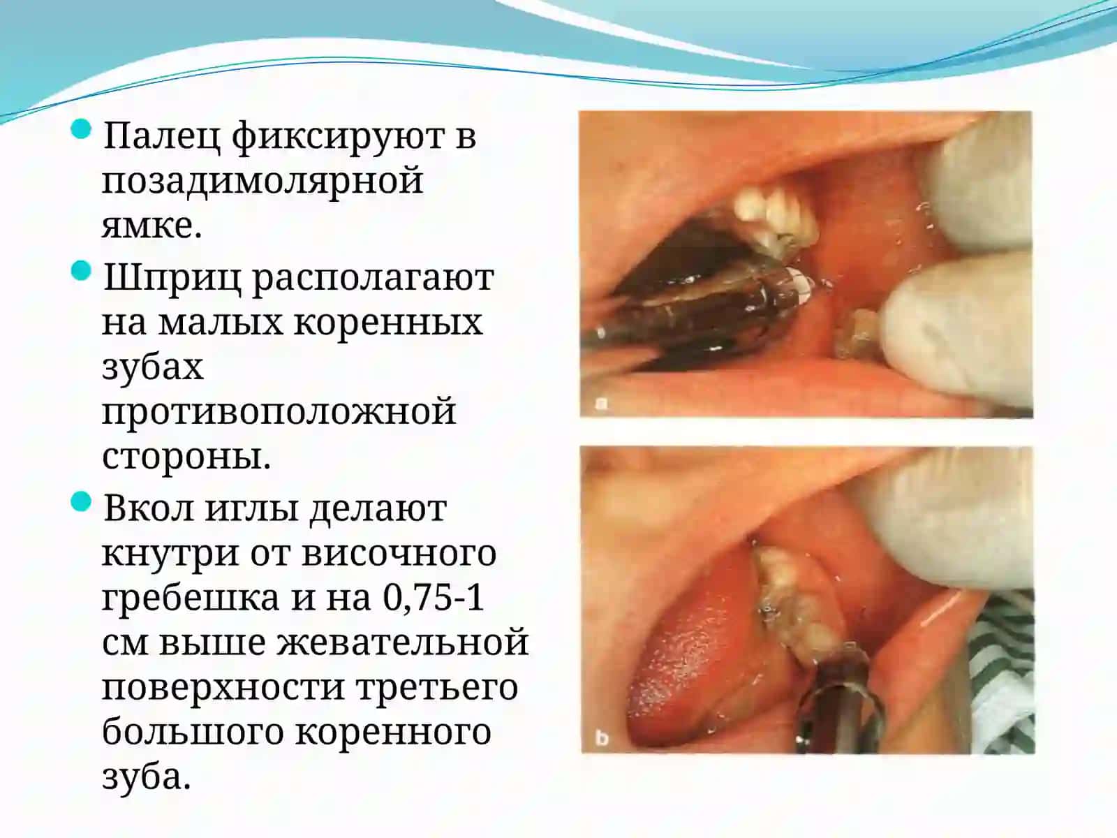 Мандибулярная иторусальная анестезия 4