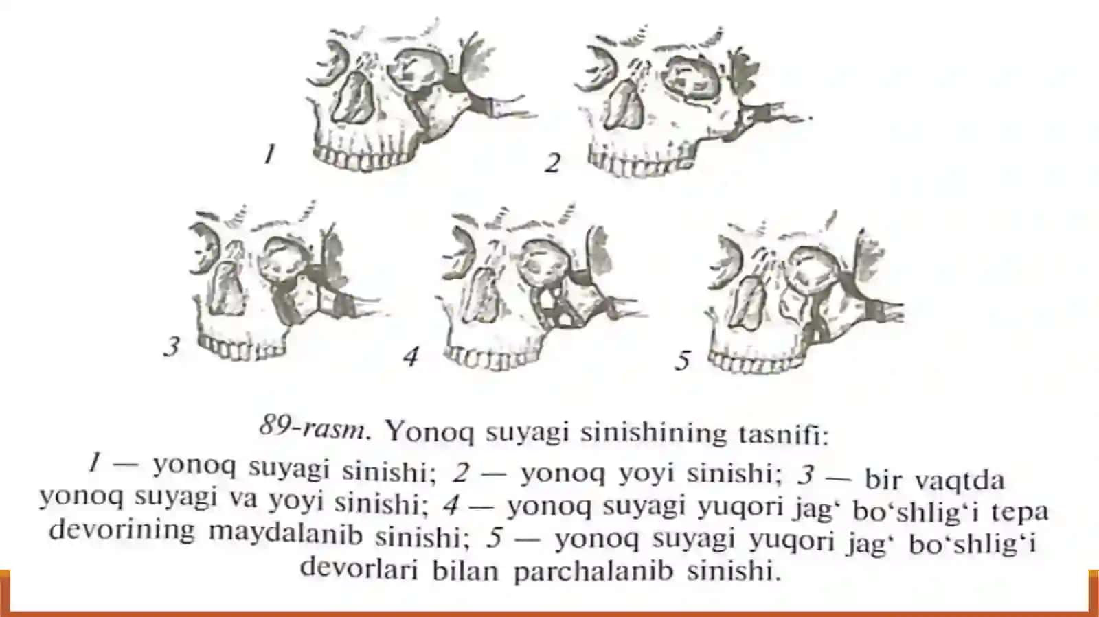 Bolalarda yuz suyaklari(yonoq suyagi va yoyi,burun suyaklari)ning jarohatlari 4