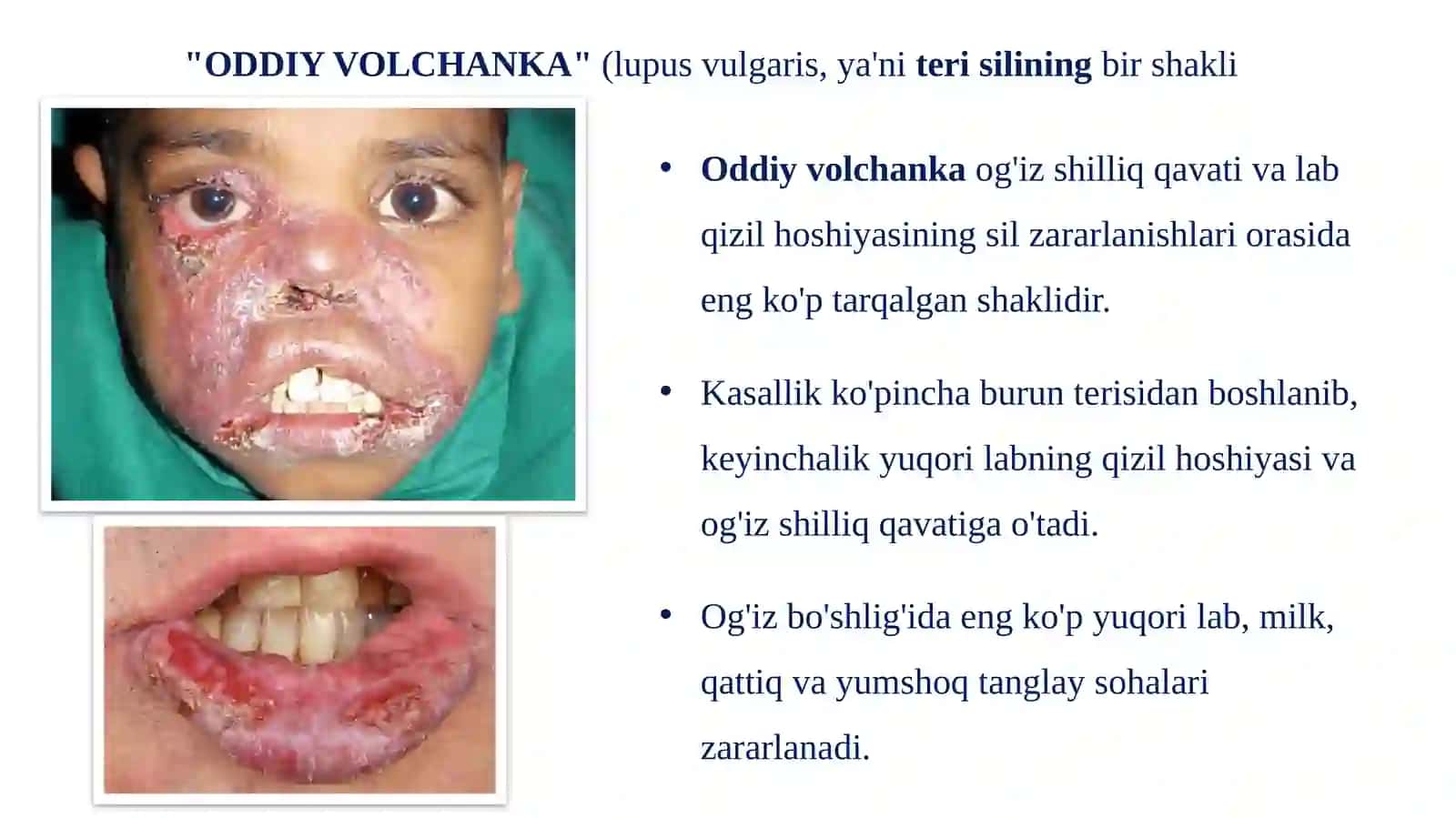 BOLALAR YOSHIDAGI OG‘IZ BO‘SHLIG‘I SHILLIQ QAVATIDA SIL VA ZAXM KASALLIKLARIDAGI O'ZGARISHLAR, KLINIK KECHISHI, TASHXISI VA DAVOSI 4