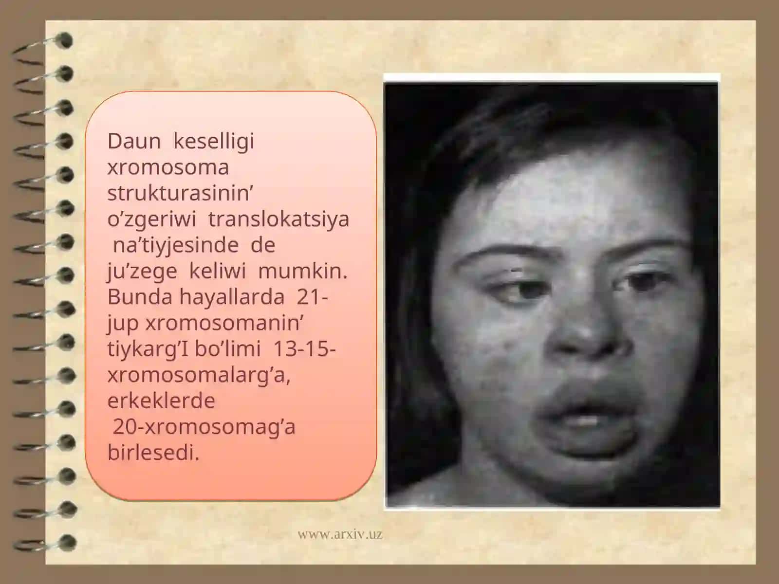 Xromosoma kesellikleri, Daun sindromi 4