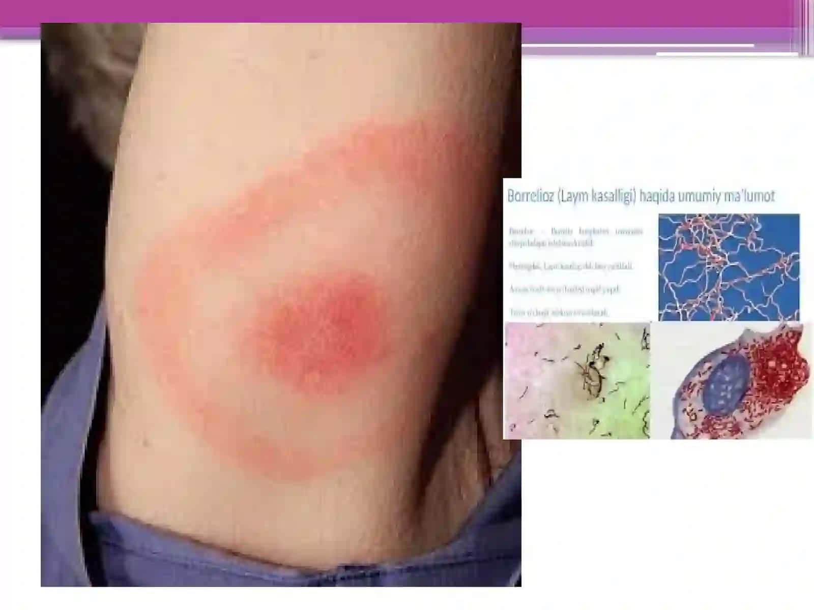 Borrelioz(laymakasalligi) va Leotospiralarmarfologiyasi 4