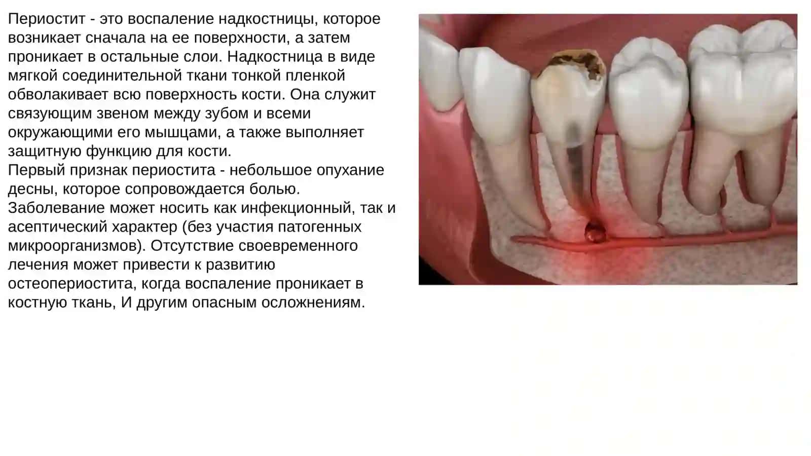 Периостит 4