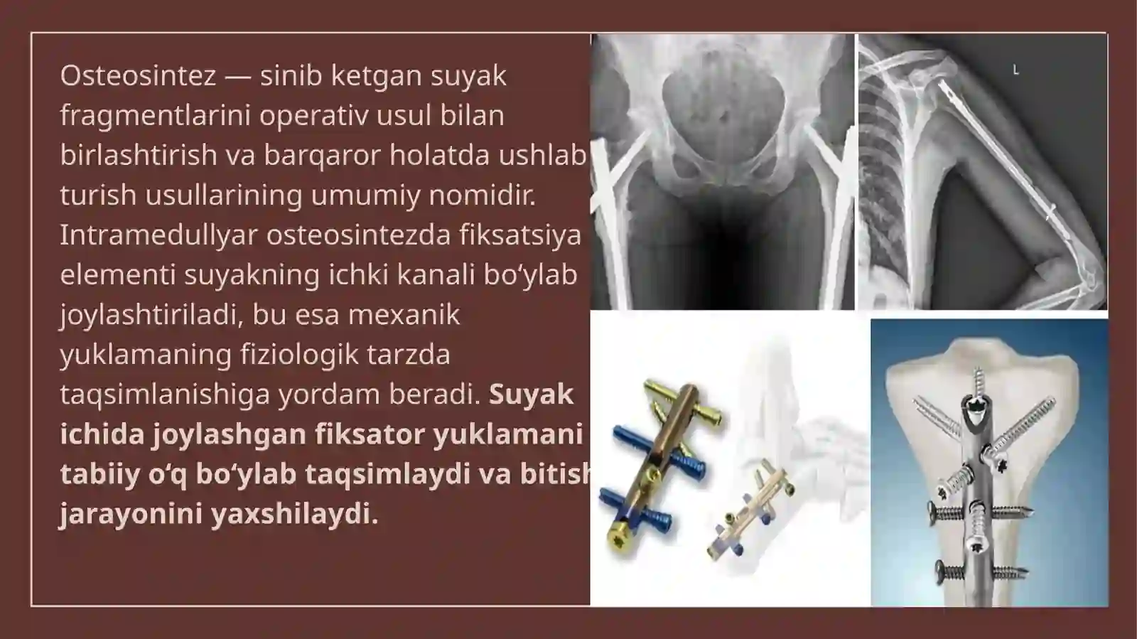 BIOS usuli (bloklovchi intramedullyar osteosintez) 4